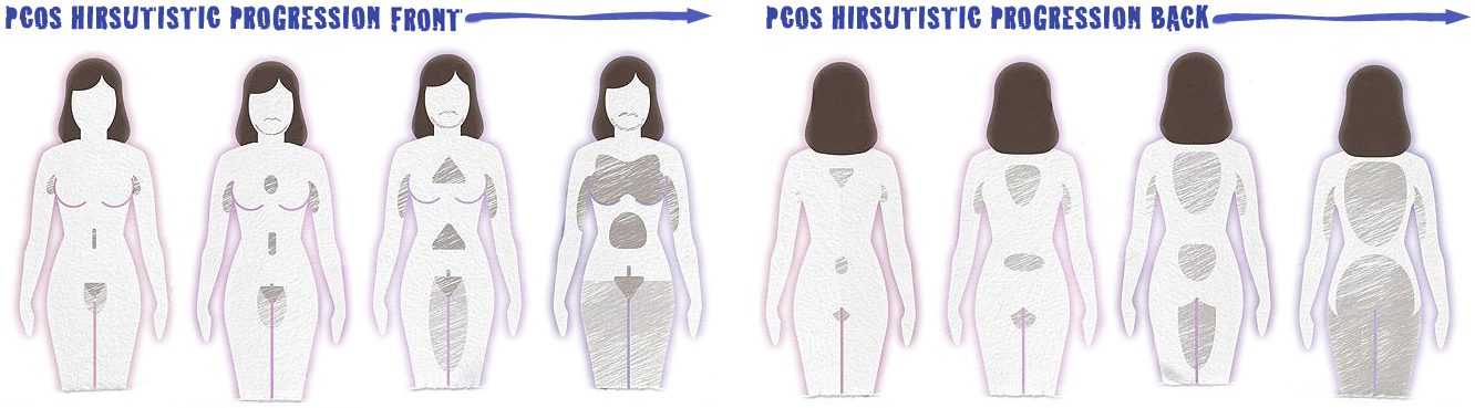 Electrolysis: The Ideal Hair Removal For Women with PCOS |Permanence