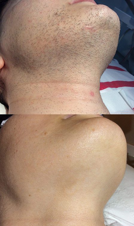 Permanent Hair Removal in Sydney | Permanence